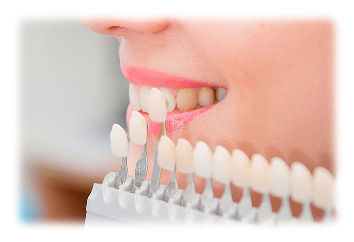 Вартість вінірів