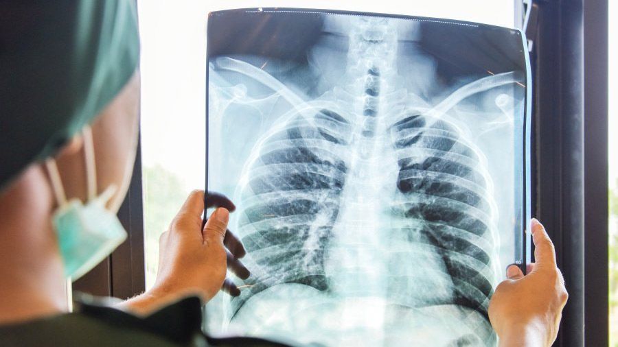 За час пандемії захворюваність на туберкульоз на Полтавщині знизилася вдвічі