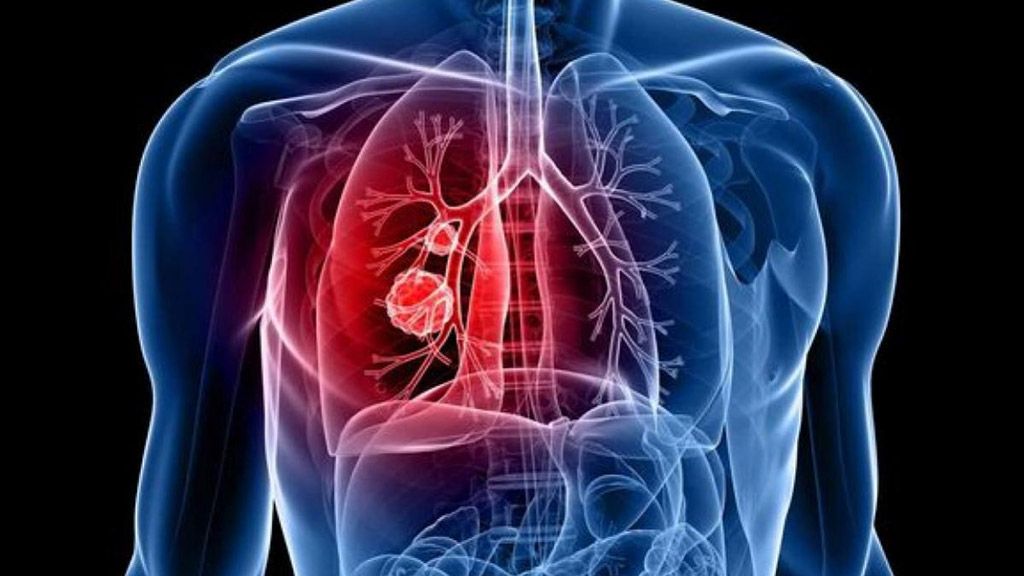 За чотири місяці на Полтавщині зареєстрували 68 хворих на туберкульоз