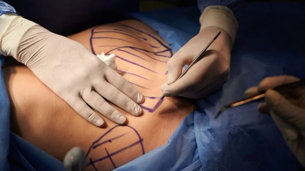 Плаский живіт назавжди: все, що ви хотіли знати про абдомінопластику в Києві