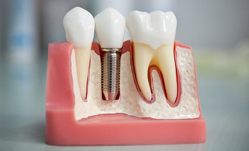 Скільки часу займає імплантація зубів?