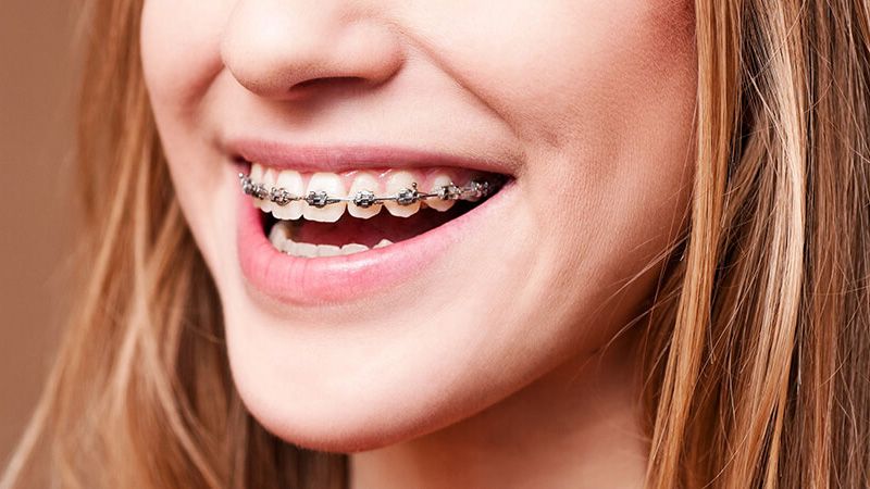 Брекети для краси і для здоров’я