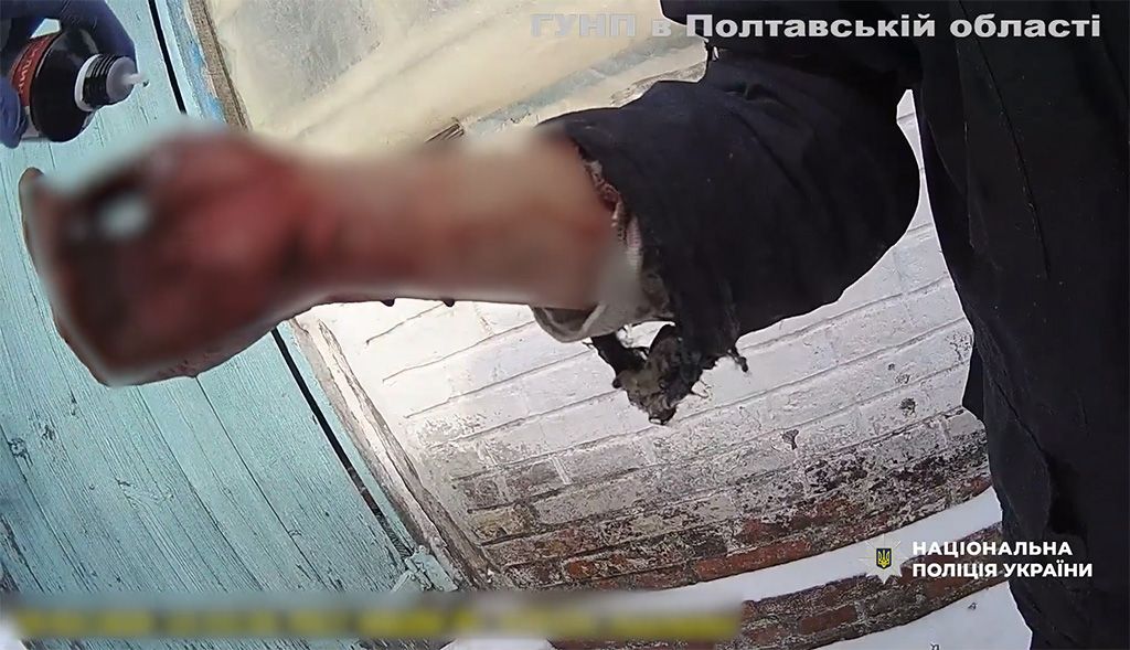 У Біликах чоловік тяжко поранився бензопилою – його врятували турнікетом