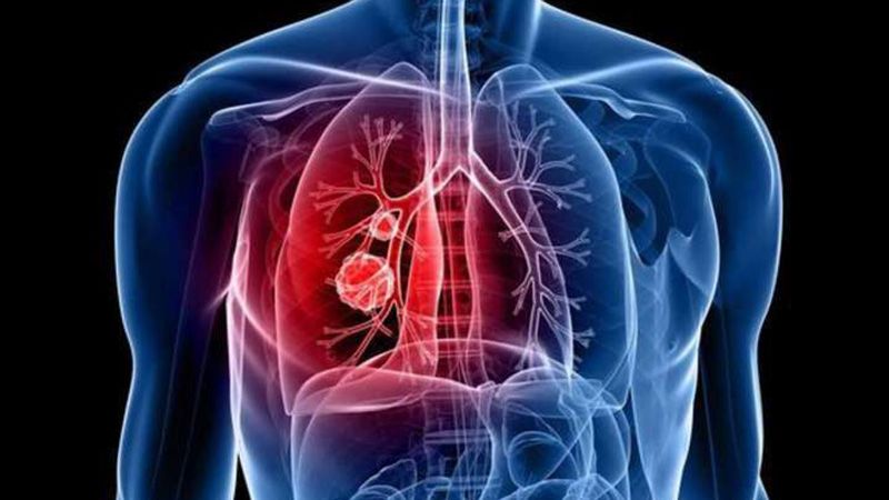 За 3 місяці медики зафіксували майже 100 випадків туберкульозу